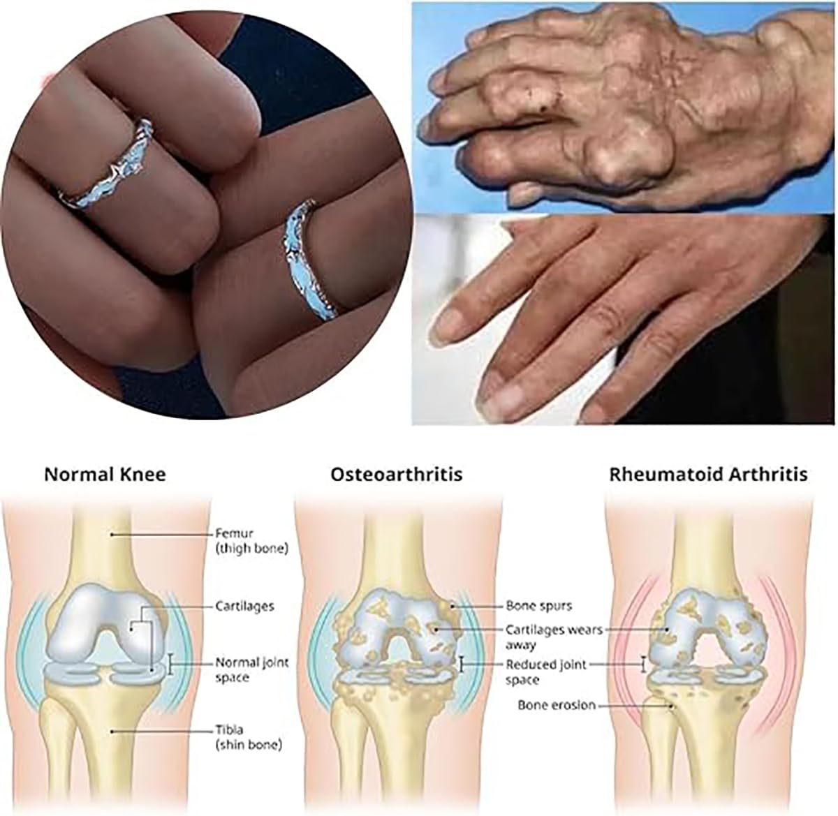 IMMUNOTRAX Magnetic Therapy Luminous Titanium Ion Adjustable Ring - Lymphatic Magtherapy Luminous Jewelry for Couples,Glow-in-Dark Wellness Ring Gift for Men/Women (B For Couples)