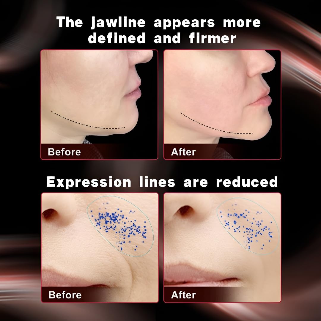 NEWA Wrinkle Reduction Device Skincare Tool for Facial Tightening. Boosts Collagen, Reduces Wrinkles. with 1 Gel Supply (Pink)