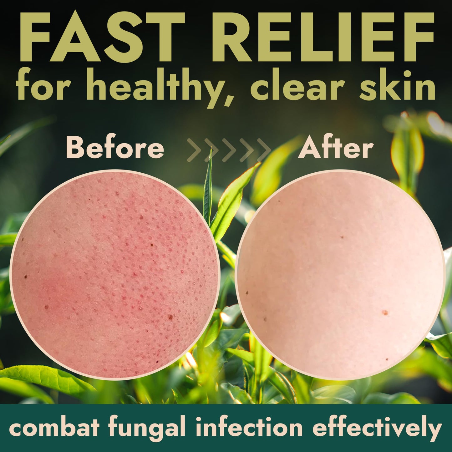 Body Scrub | Tea Tree Oil Scrub with Manuka Honey and Salicylic Acid | Fights Jock Itch, Acne, Rashes & Body Odor | Anti Fungal Natural Body Exfoliator for Men and Women with Free Scrubber Brush