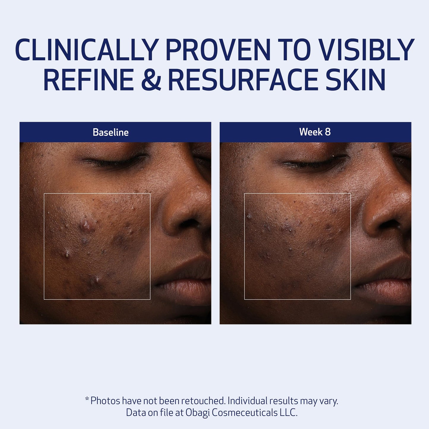 Obagi Medical Retinol + PHA Refining Night Cream - Clinically Proven, Dual-Action, Overnight Anti-Aging Face Cream for Smoother, Renewed Skin & a More Even-Looking Complexion - 1.7 Oz