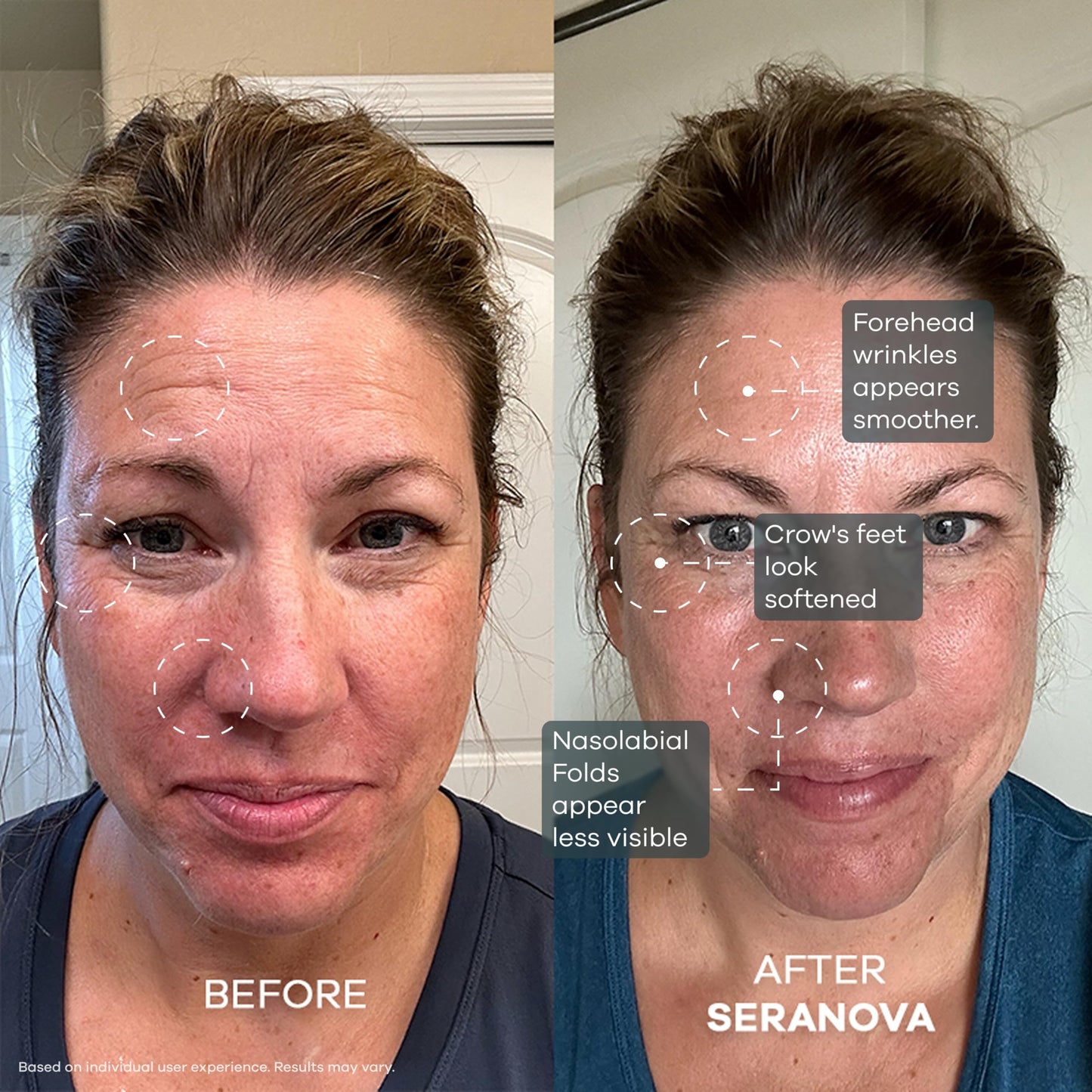Seranova Micro Infusion System for Face & Neck 0.05mm Stamp with Hyaluronic Acid & Collagen Peptide Serum for Firmer Smoother-Looking Skin, Easy 5-Minute At-Home Skin Care Application - 3 Month Supply